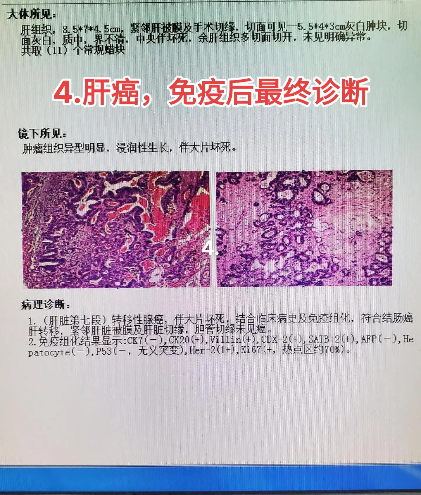 肝癌 结肠癌肝转移
