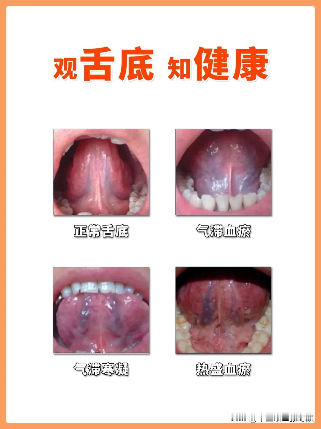 舌下血管又黑又紫，都是这些问题在作怪
千万不要不当回事[赞][赞][赞]

正常