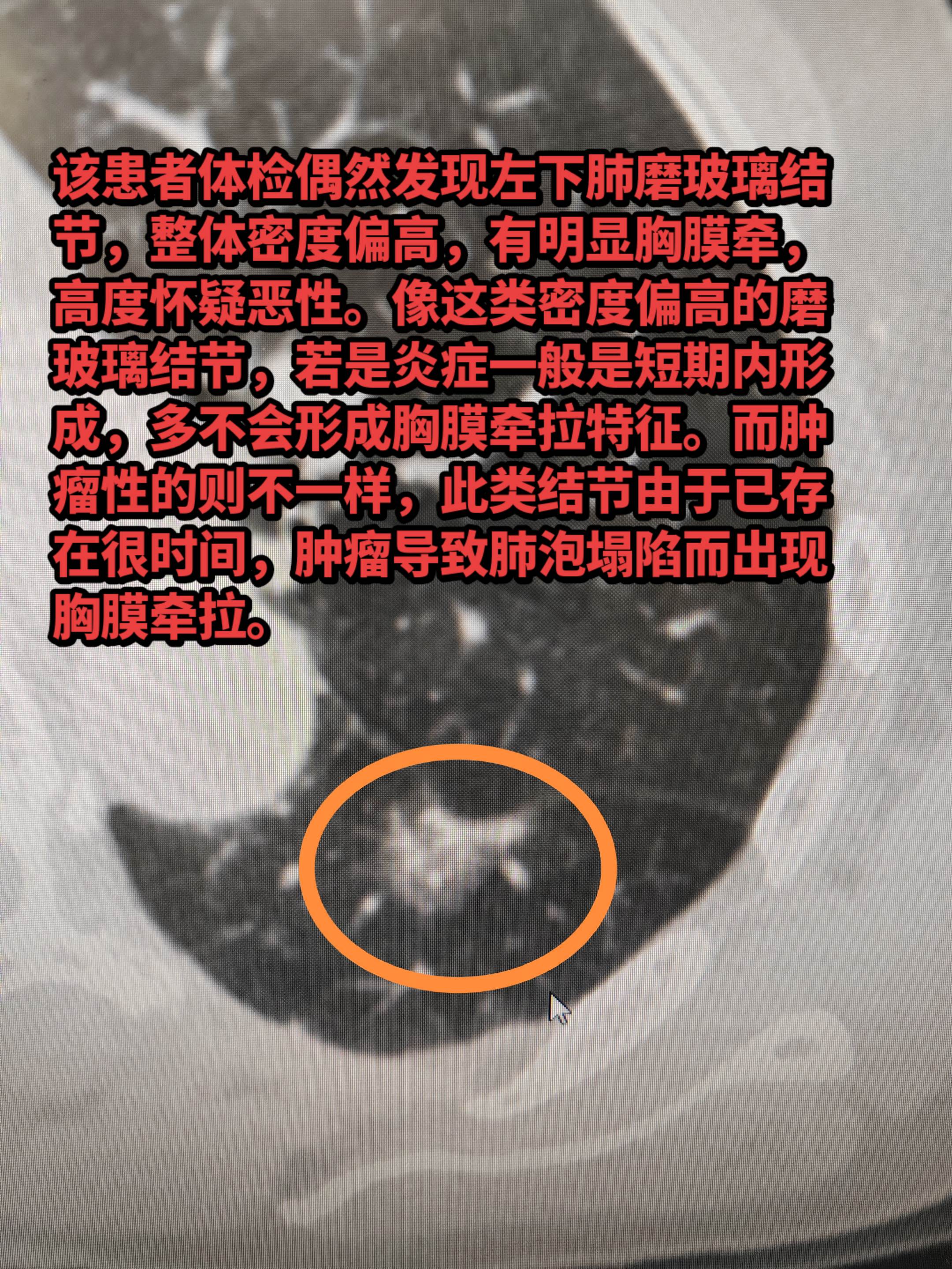 磨玻璃结节出现胸膜牵拉需警惕！该患者体检偶然发现左下肺磨玻璃结节，整体...
