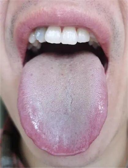 这种舌头你都不管，等它自己自愈吗？简直在作死边缘，让人头疼
观察这舌头，可以明显
