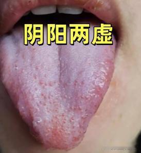 龟鹿二仙胶对应的“阴阳两虚偏肾精亏虚”舌象及辨证解析
中医认为“精能生阴，精能化
