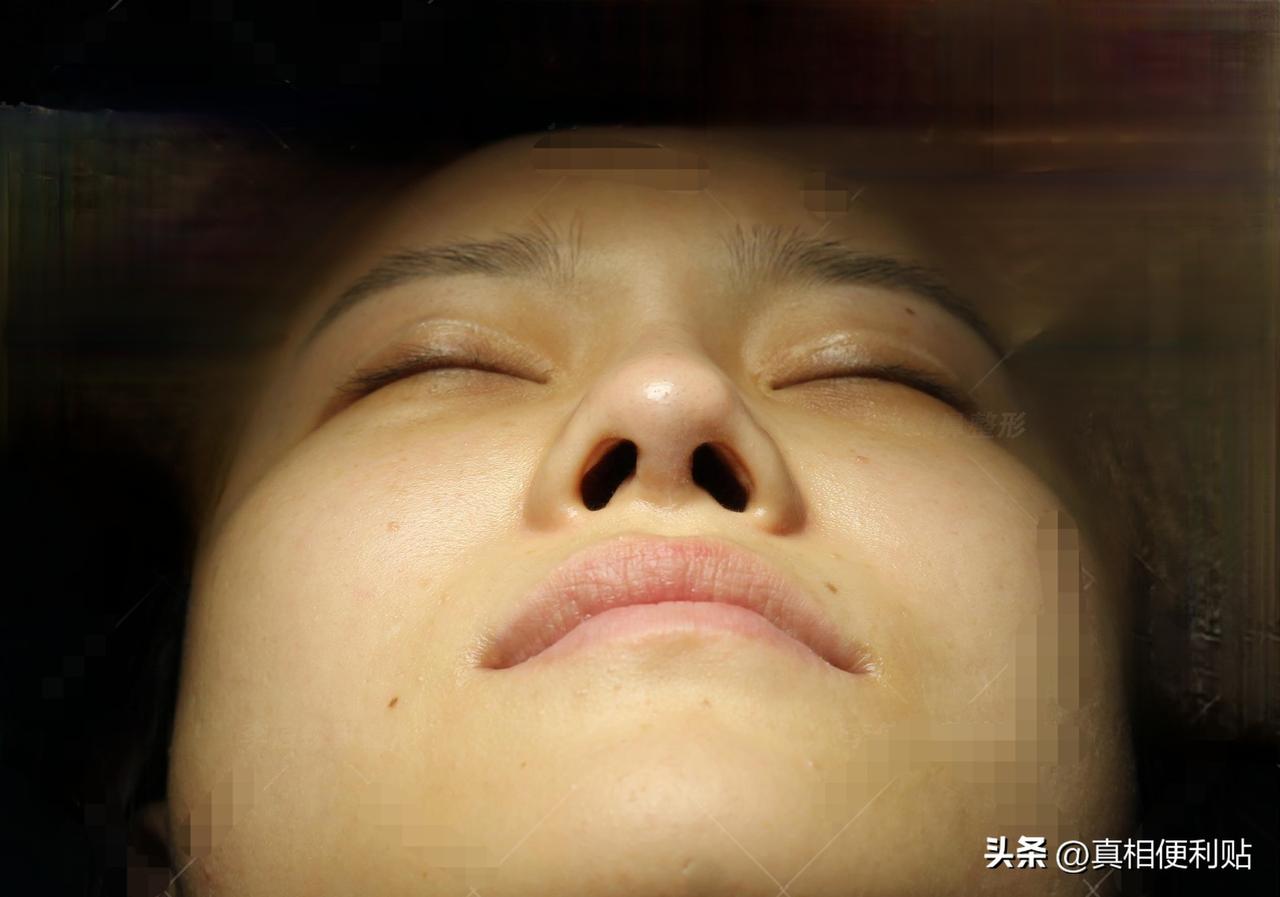 湖南长沙，一女子去隆鼻，打完麻药睡了一觉醒来，医生却告诉她，他和医美机构价格没谈