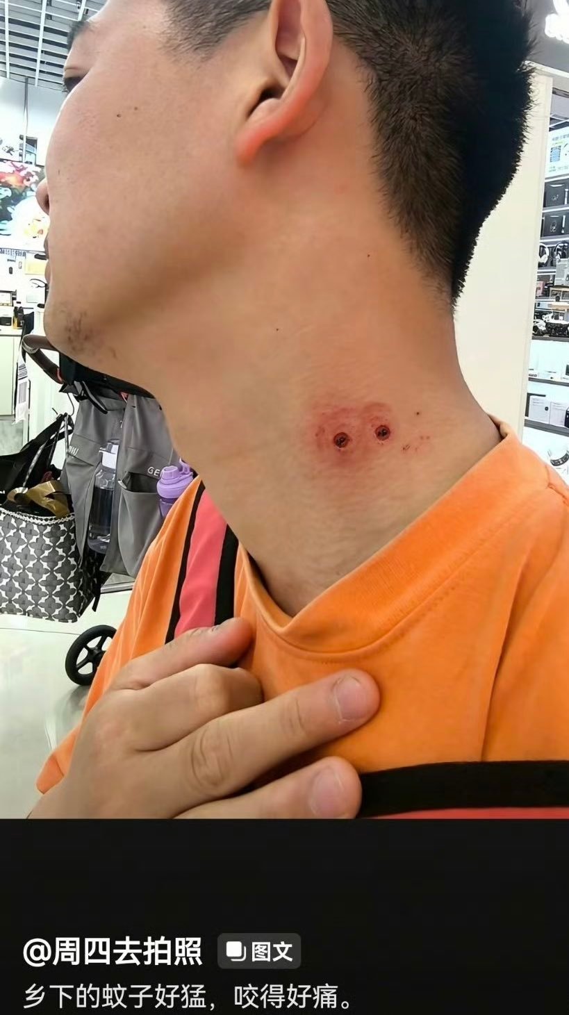 这是去罗马尼亚，被德古拉蚊子咬了？ 