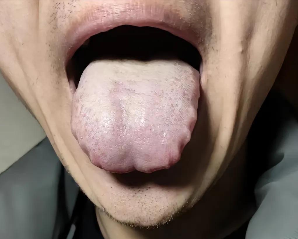 一年一做次检查，26岁的年轻小伙，两肺多发小结节
患者主诉：每年他就会做体检，2