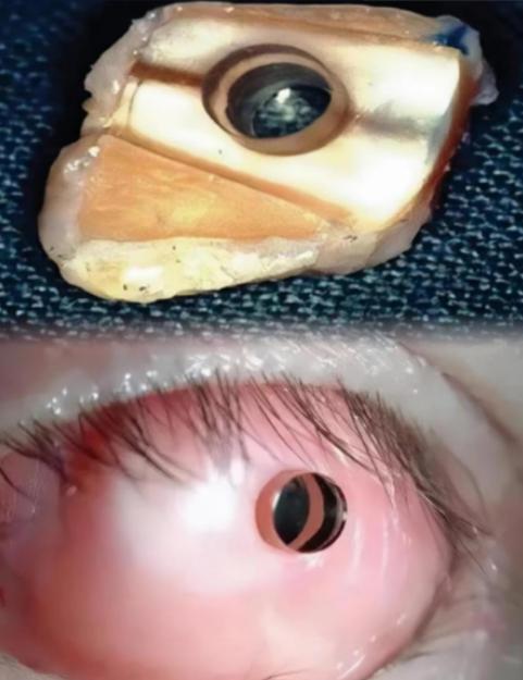 “感谢你的牙齿，让我又能看见这个世界！”2008年，爱尔兰一盲人男子因意外失明3