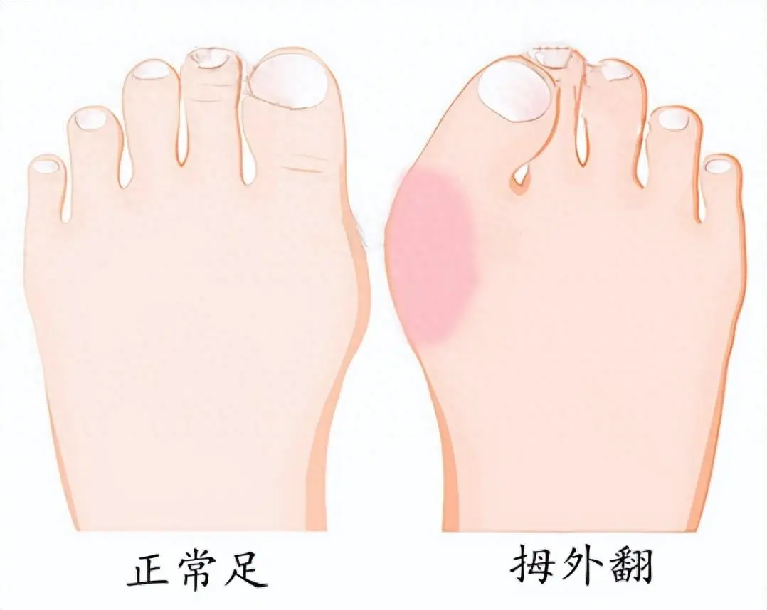 再谈拇外翻的保守治疗