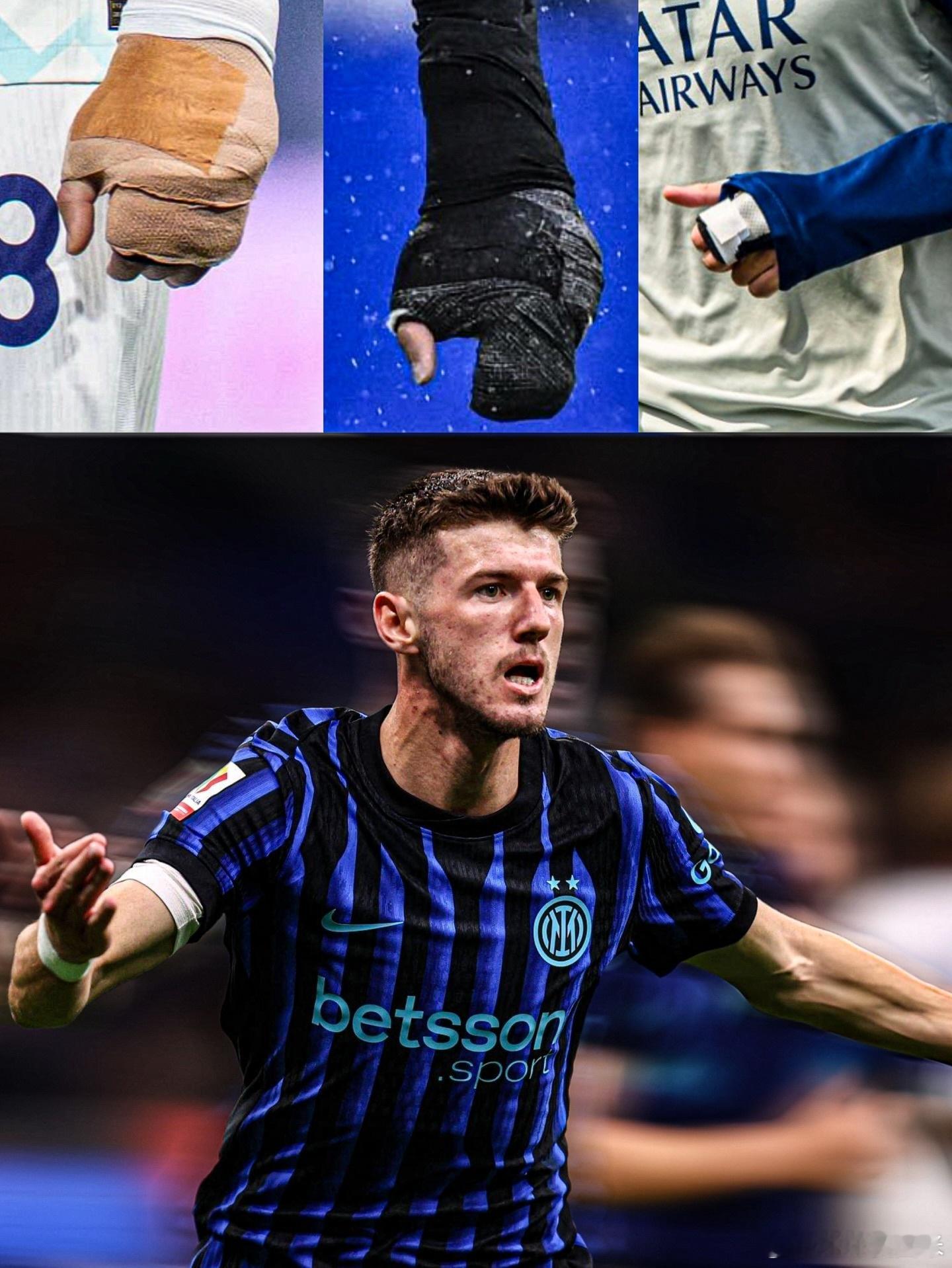 【硬汉】图片就是苏西奇受伤的样子，他没有休息强忍着坚持到康复。国际米兰热点现场意