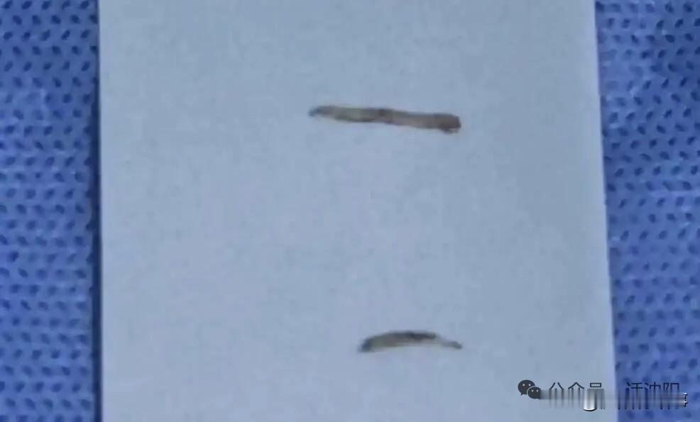 20岁女生腹痛高烧！腹腔流脓做手术！元凶竟是人人都在用的一次性筷子！[捂脸]
 