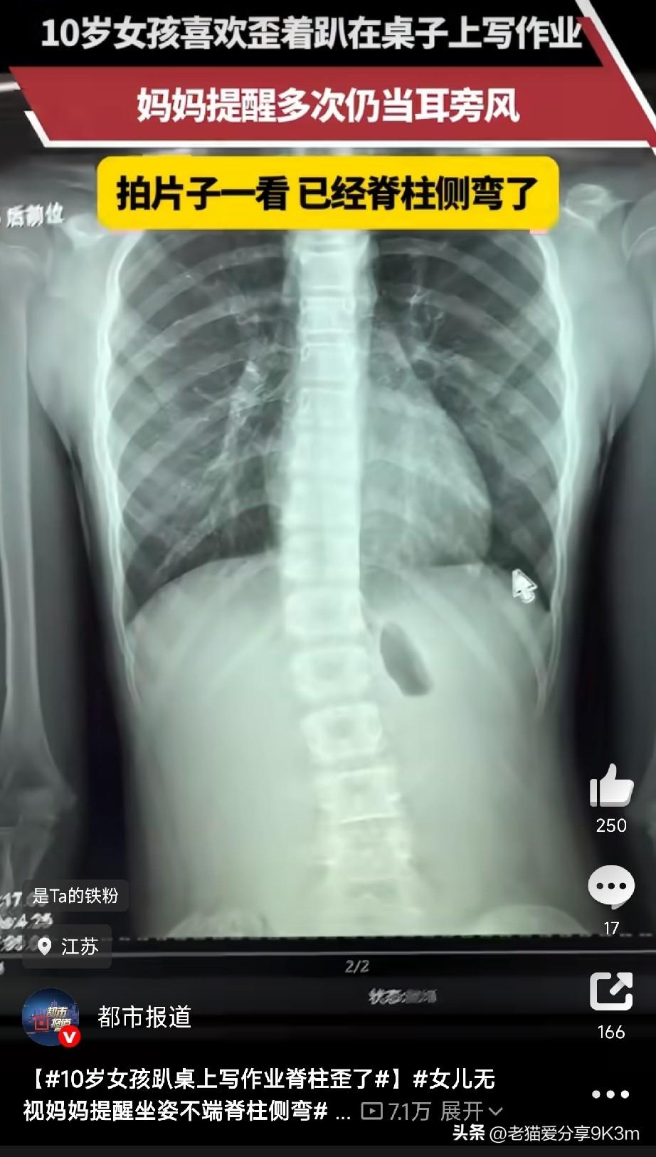 江苏一位10岁女孩，就因为长期歪着趴在桌上写作业，把脊柱给“写歪了”！

当妈的
