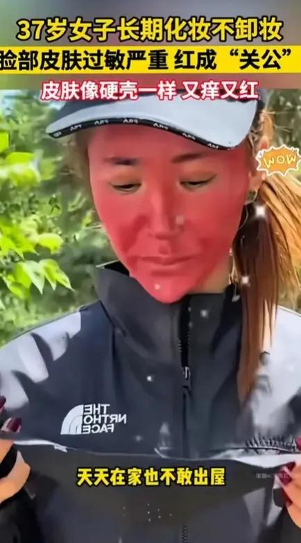 云南女子由于爱美，喜欢化妆，长期不卸妆，导致皮肤严重过敏红成关公脸，脸红的吓人，