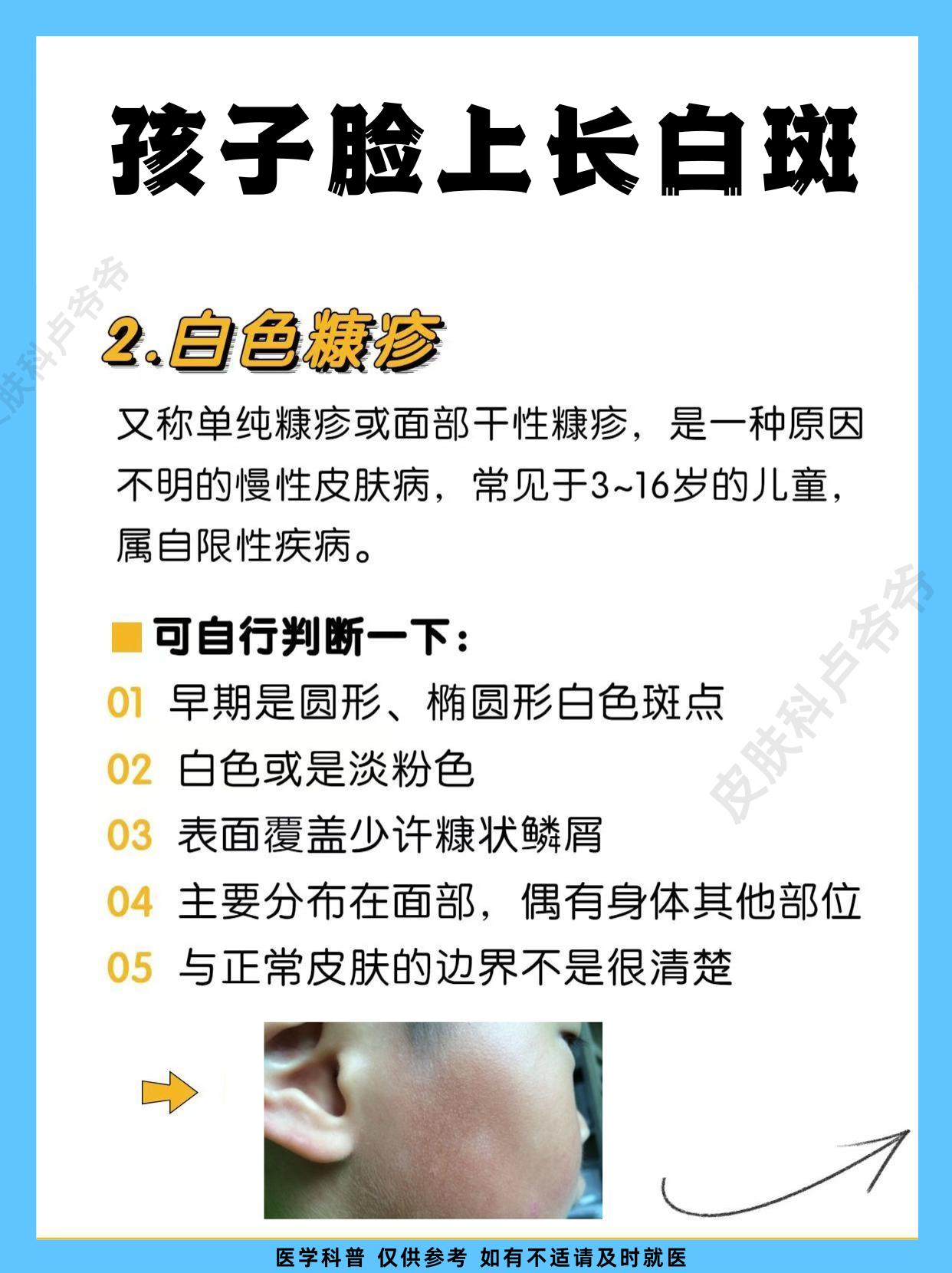 白癜风 白斑 医学科普 江西