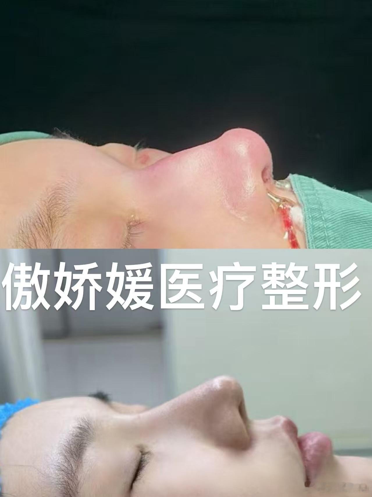 鼻子改成了微起伏 大家觉得我之前鼻子好看还是现在好看？我还做了精灵耳和adm卧蚕