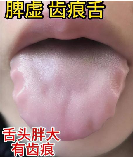 脾虚齿痕舌、肝郁齿痕舌、阳虚齿痕舌，3个中成药，疏肝 健脾 温阳 消齿痕！！！