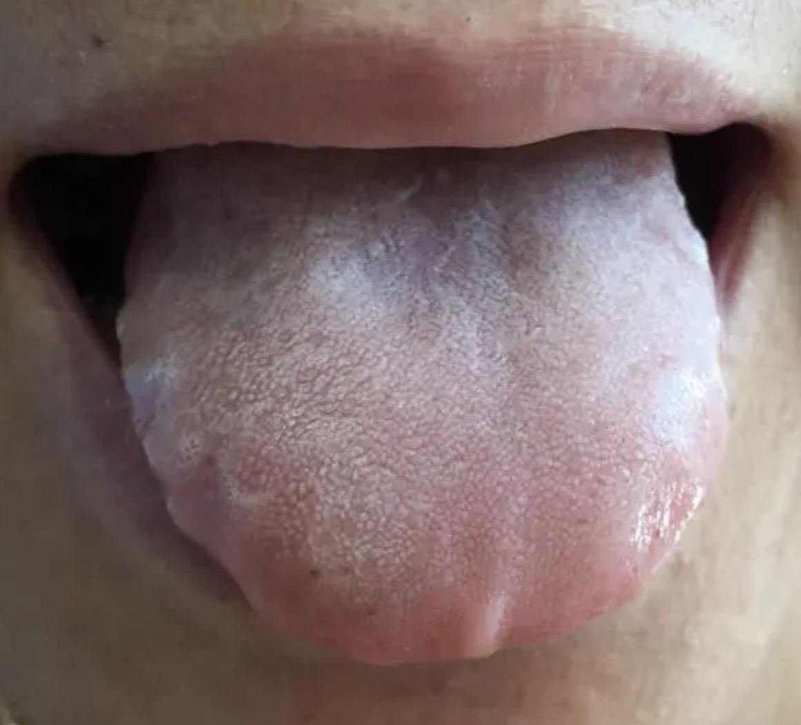 张女士泡沫尿4年了，刚看到这患者的时候看起来也没有精气神儿，双下肢浮肿...