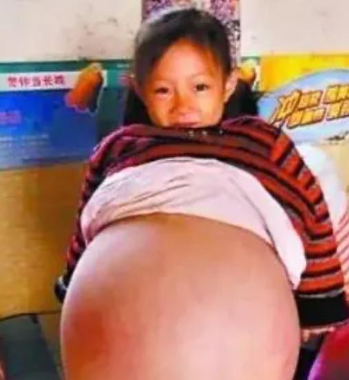 在山西的一个寒冷冬日，四岁的小云星腹部鼓胀如足月孕妇，多位医生先后给出了生命仅剩