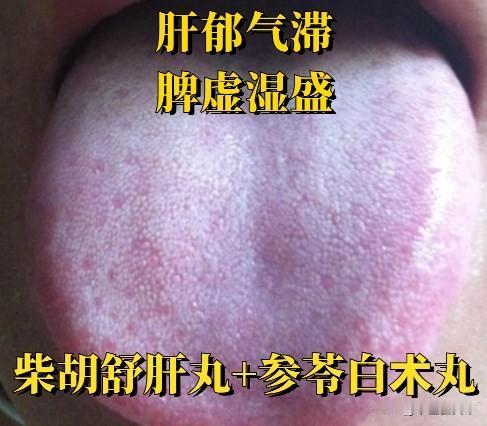 柴胡舒肝丸巧搭配，不止疏肝解郁，还能轻松调理五种情况；
一、柴胡舒肝丸+参苓白术