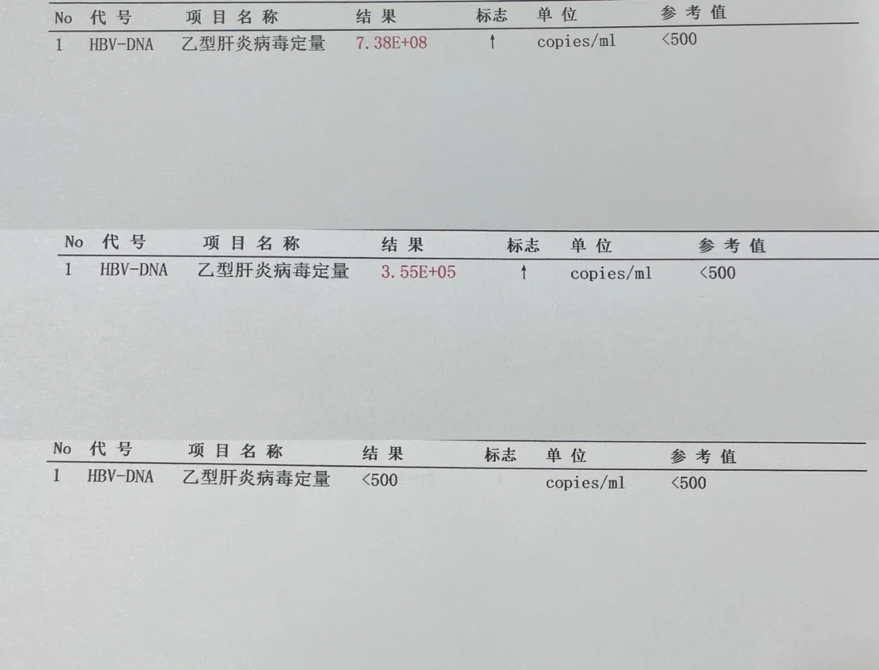 2025年好消息！大三阳患者，达到抗病毒治疗标准，经过治疗病毒量从8次...