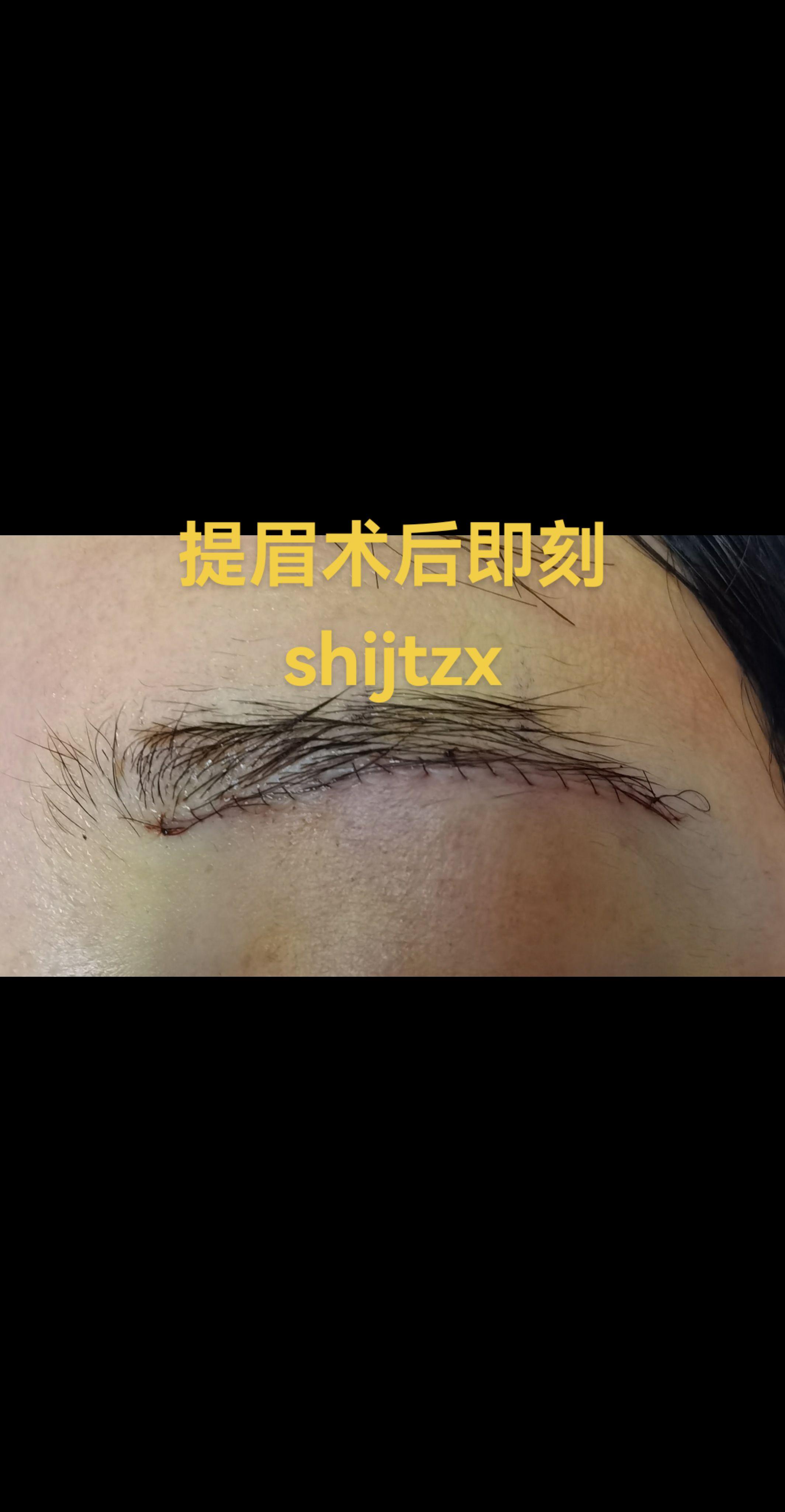 眉提升术。提眉术后即刻