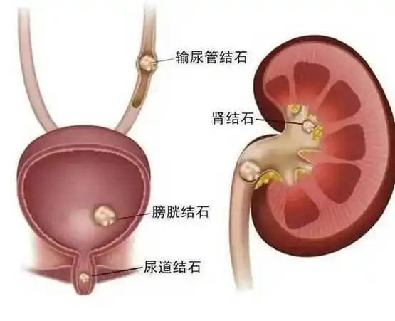 肾结石、尿路结石，不但能治，而且很好治，不用再辗转多家医院了

尿路结石常以腰部