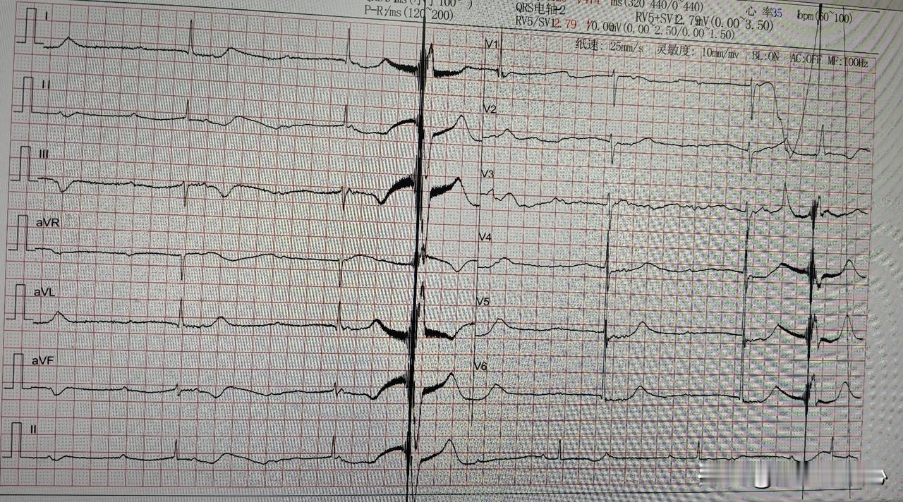 心跳只有每分钟30次，血压却高达220／120毫米汞柱，究竟是怎么回事？
86岁