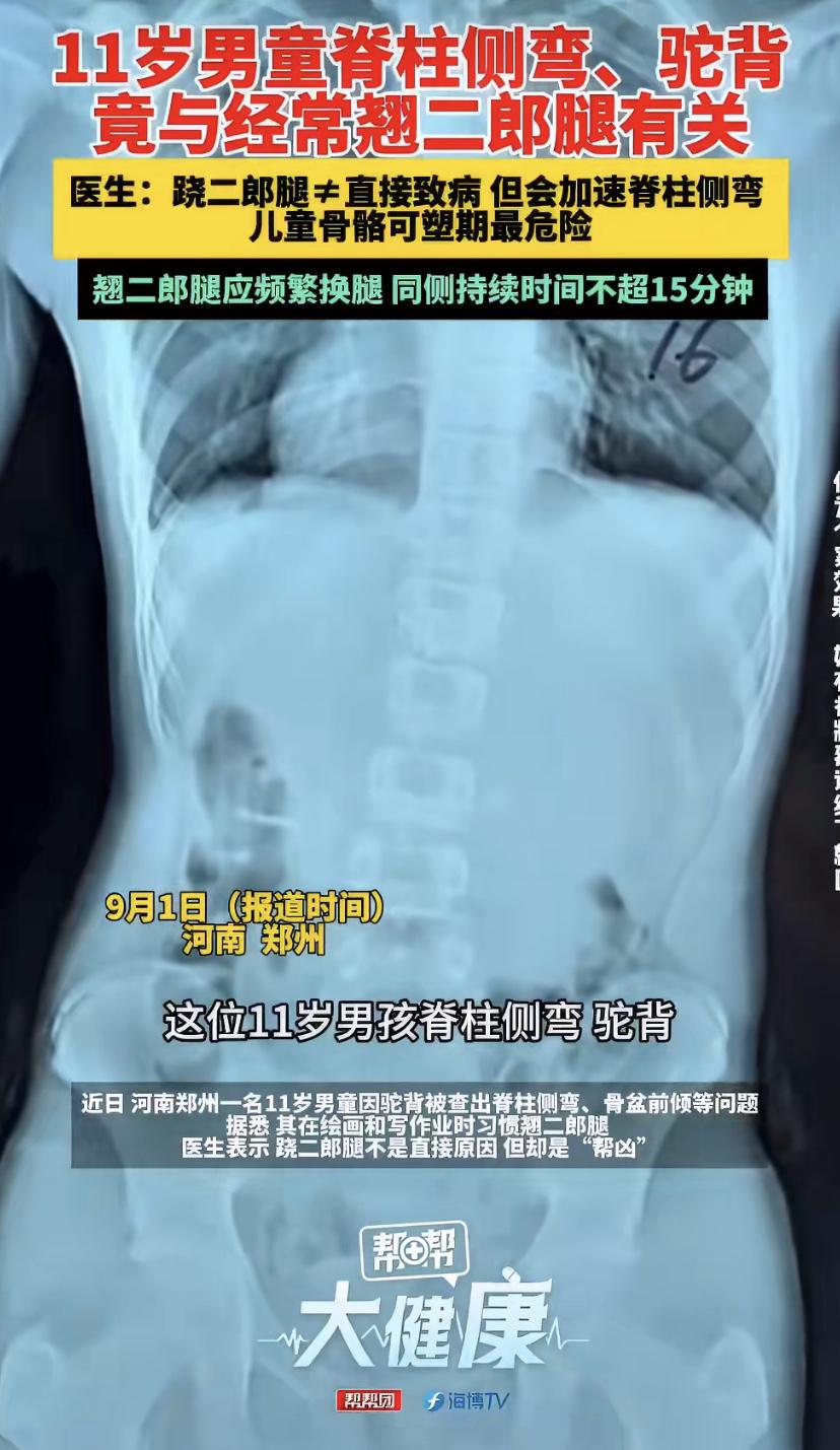 11岁男孩天天跷二郎腿画画，结果脊柱弯了!医生紧急提醒：这习惯太伤孩子
郑州一个