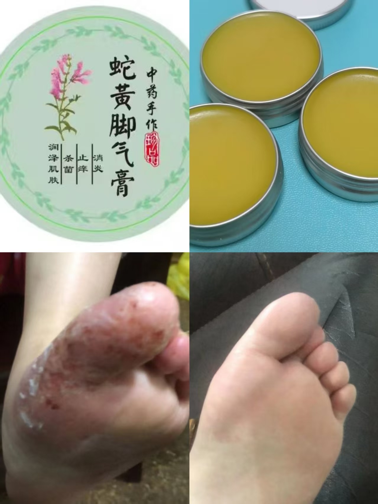 用了脚气膏，脚患处恢复明显，这款复购率很高。 