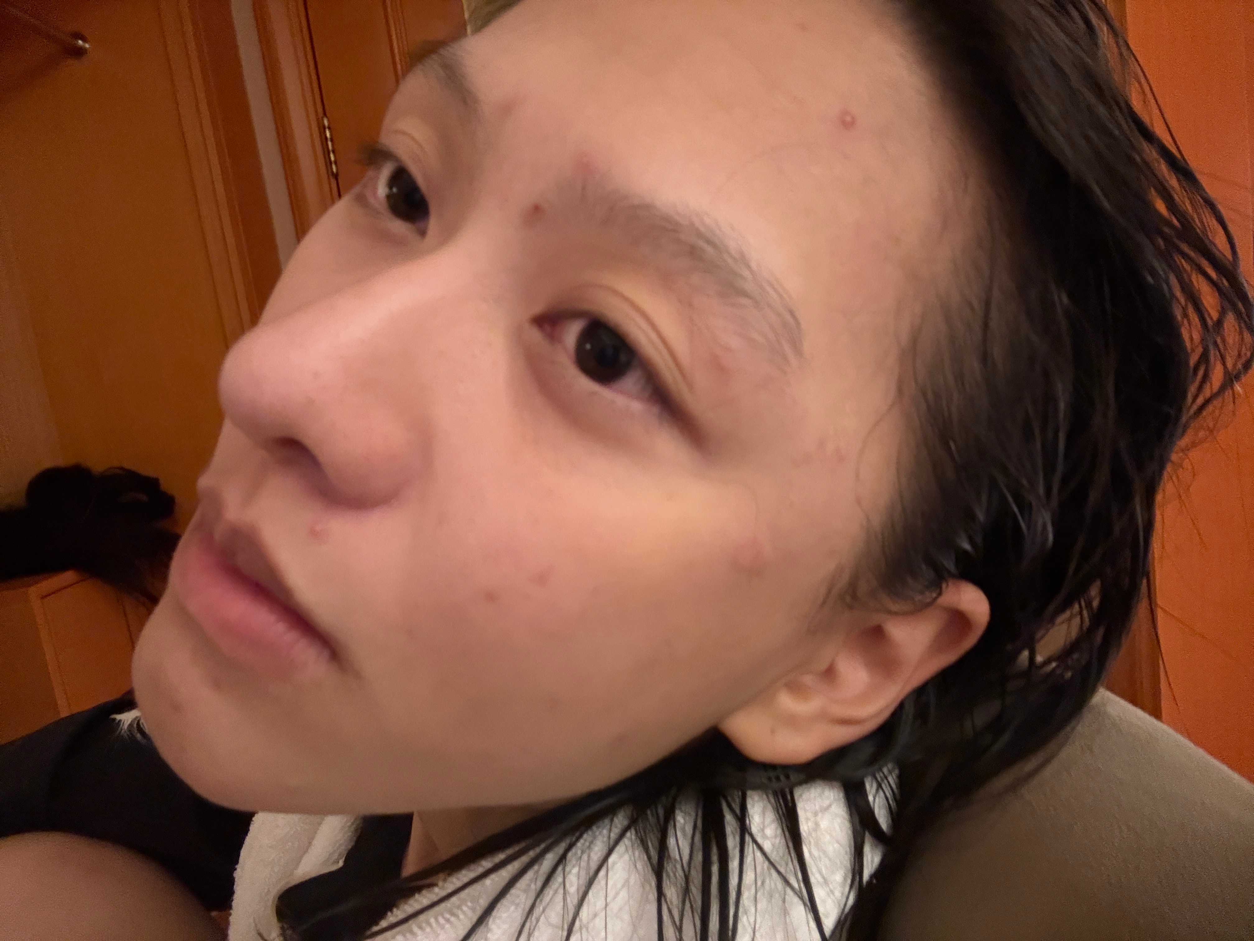近期爆痘中 ​​​