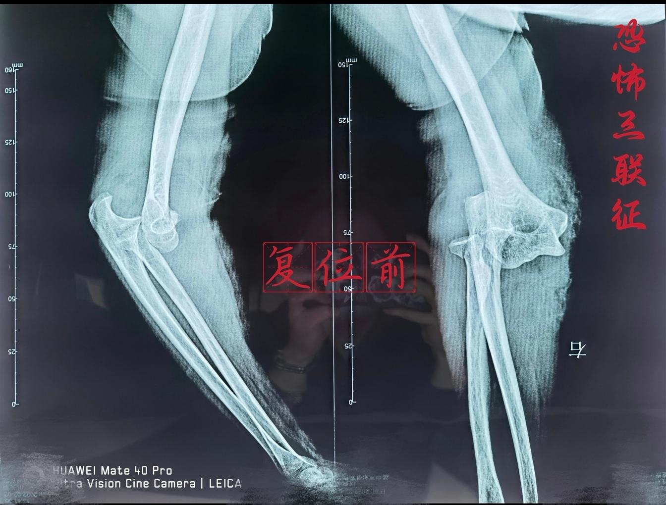 跌倒外伤导致的肘关节恐怖三联征，外旋复位失败后，于我院二次手法复位。良好的复位效果可以减轻血管神经受压，更好的评估关节的稳定性和损伤程度，更合理的制定手术方案！