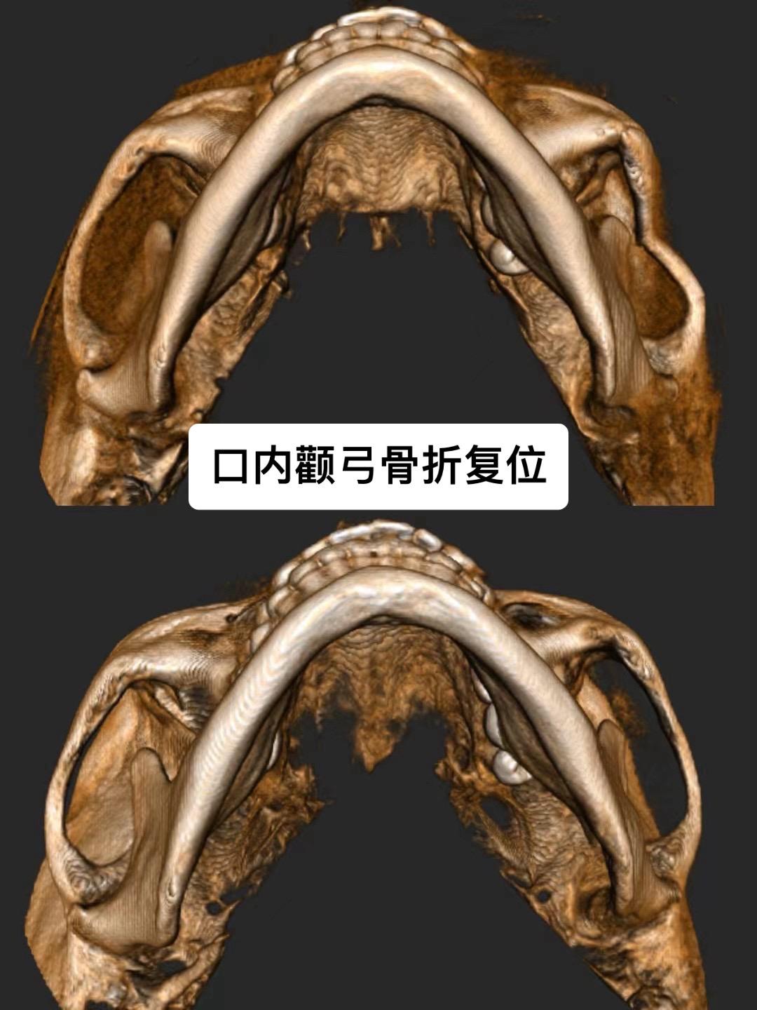 颧弓M型骨折。前段时间的患者，一大早云大医院麻醉科的老师给我打电话，说亲戚面部受伤骨折要做手术，我让他发片子看一下，发现颧弓M型骨折，正好总院门诊，让她过来。
门诊局麻从切开到复查片子，不到两分钟，复查片子，效果完美。
省了几万块钱不说，还没有面部瘢痕，满意。