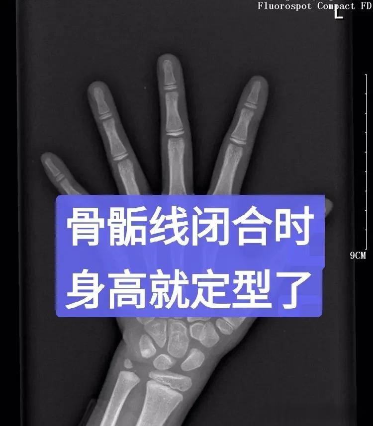 孩子测骨龄太重要了！看完这两个门诊案例就明白了
 
今天先给大家分享两个案例，目