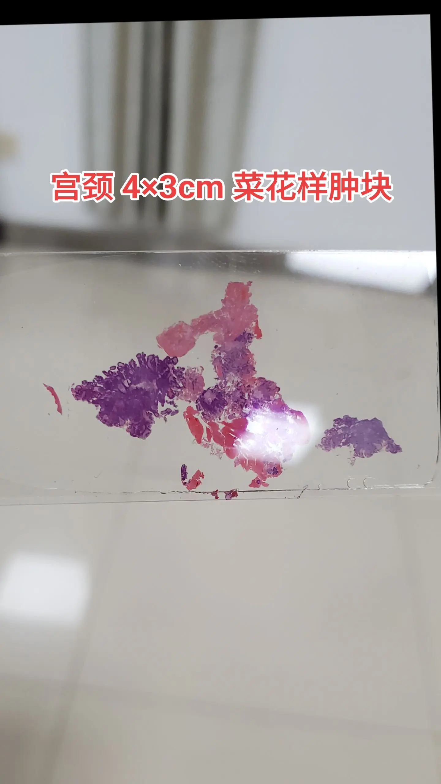 宫颈癌