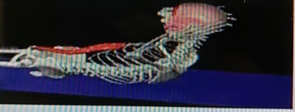 很多人以为腰间盘突出就是久坐闹的，其实没这么简单。医生说，根源不在腰，而在髋关节