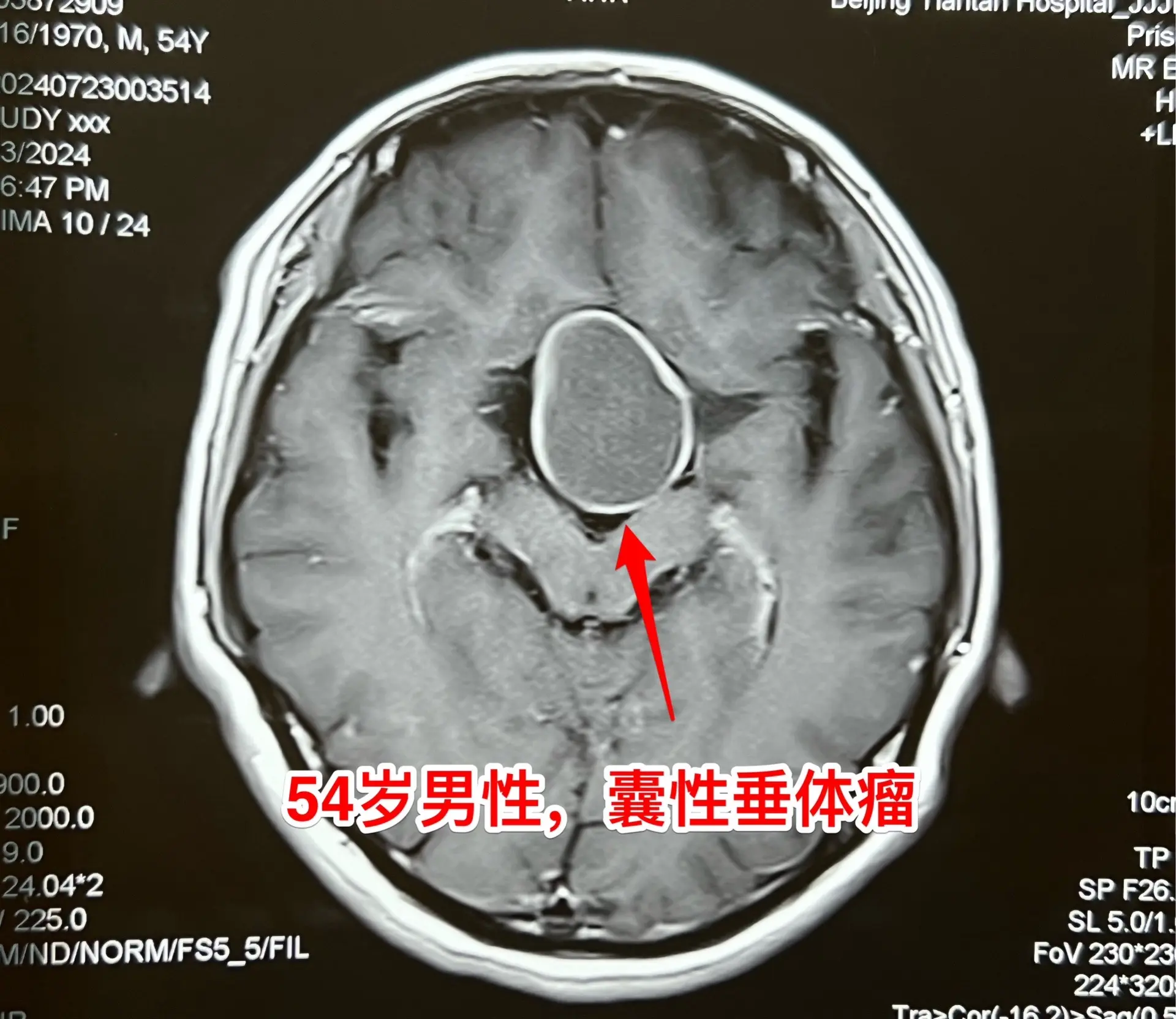 中元节是不是不适合作手术？昨天8月18号是中元节，我们科在上周提前安排...