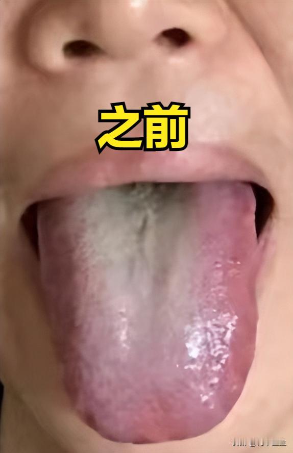 舌色发紫请注意！只清血瘀没用，气血不足，病根不净，听我的话，对比很明显

伸出舌