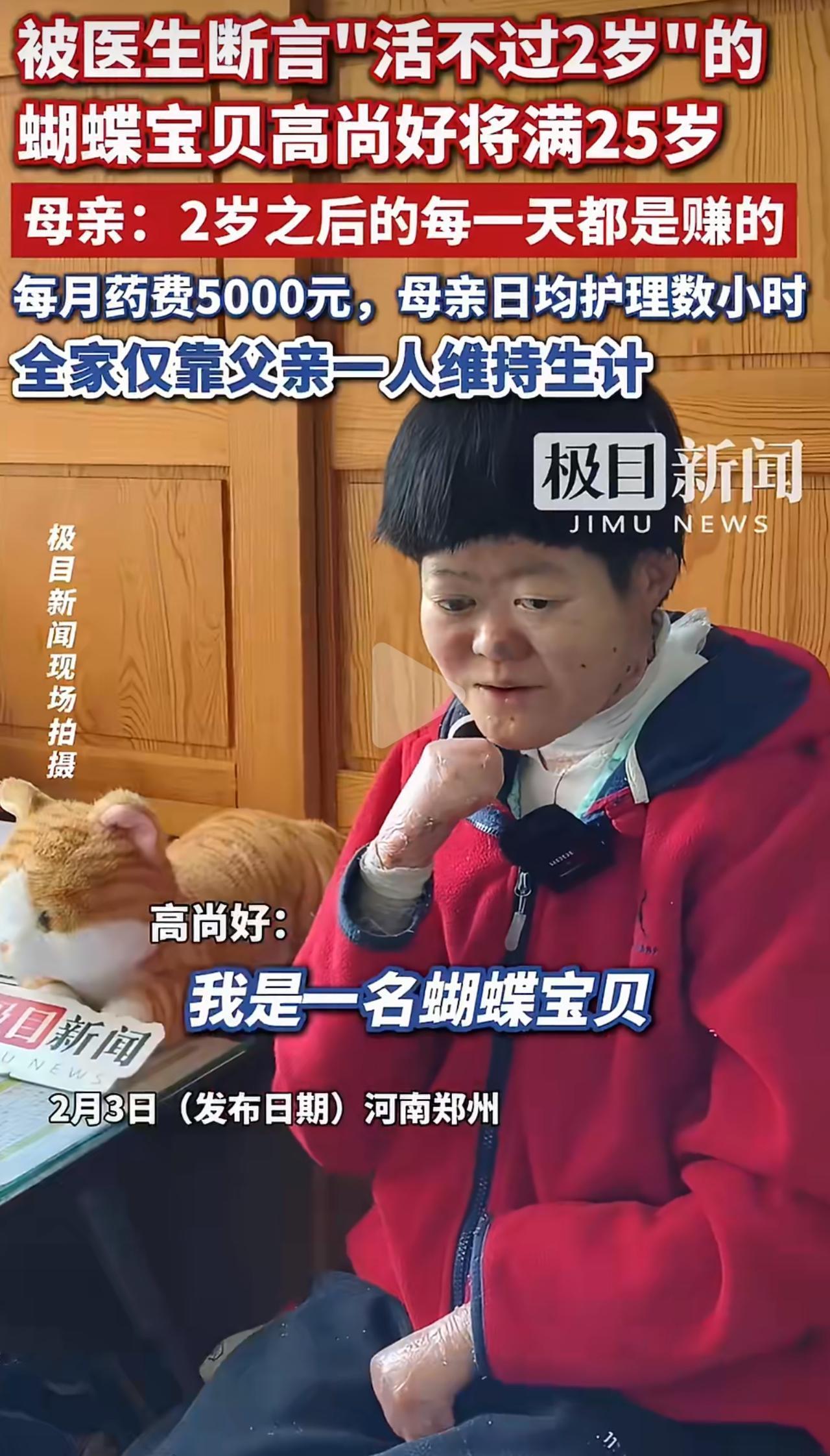 活不过两岁的魔咒，她硬生生扛了25年，5次分指手术，手指还是紧紧粘成拳头，这就是