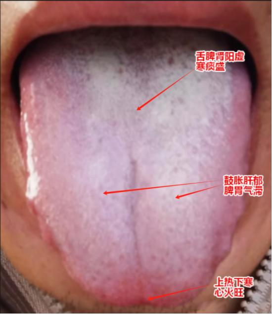 这种白腻厚苔，脾肾阳虚、痰湿重的舌头，用桂附地黄芄+六君芄来温阳化痰，无效还上火