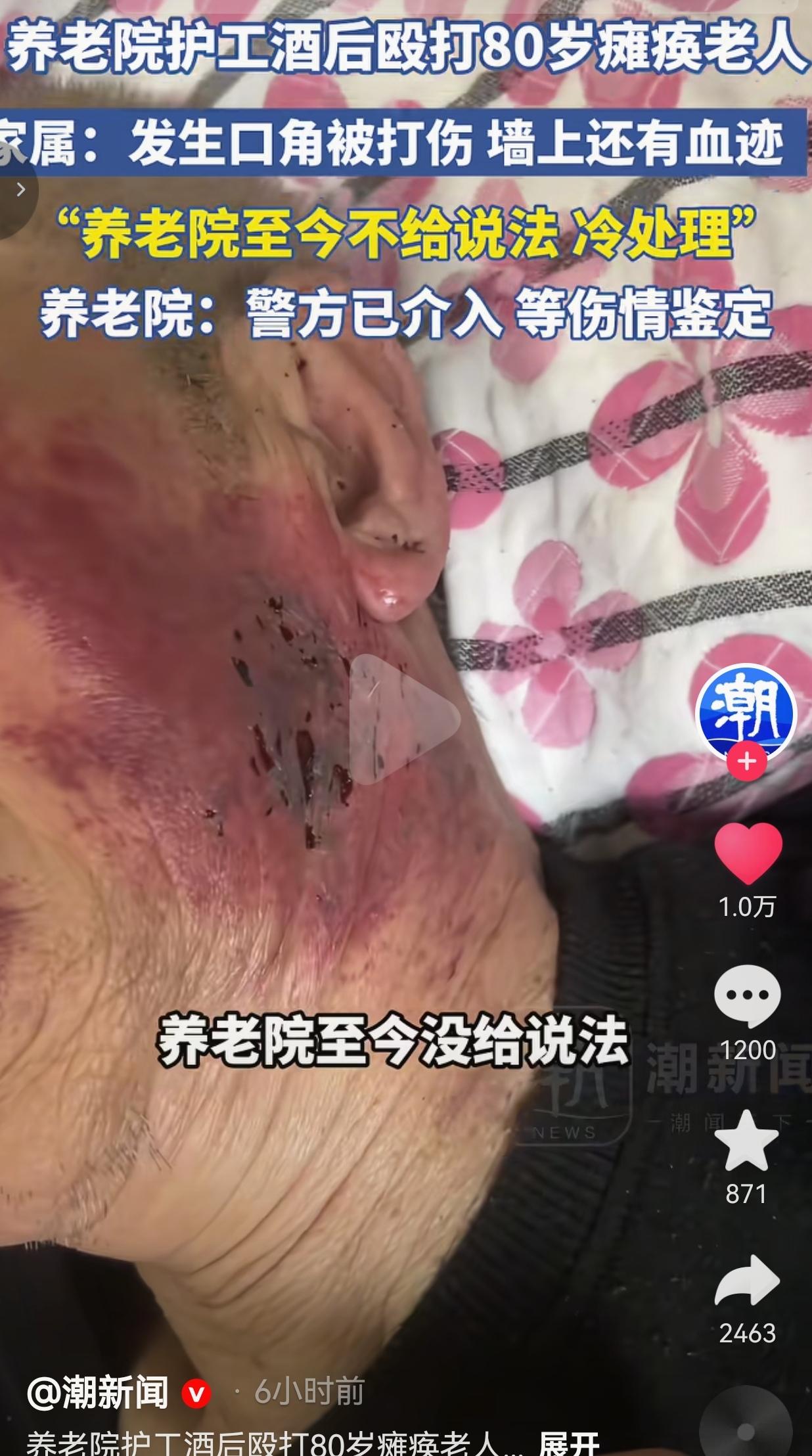 80岁瘫痪老人被养老院护工酒后殴打！墙角还有血迹，养老院全程冷处理！
 
天津的