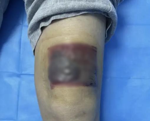 “悲剧还是发生了！”近日，湖南长沙，一男子为缓解关节疼痛，连续三晚将暖宝宝贴在膝