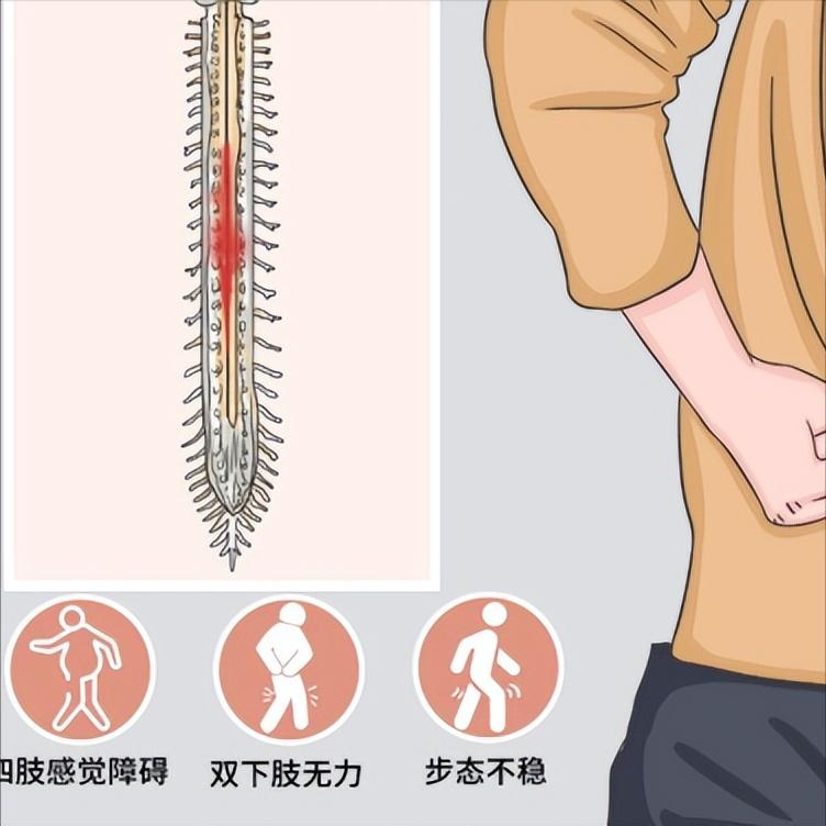 脊髓损伤位置越高，瘫痪范围越大？

同样是脊髓损伤，为什么有人只是单腿不好使，有