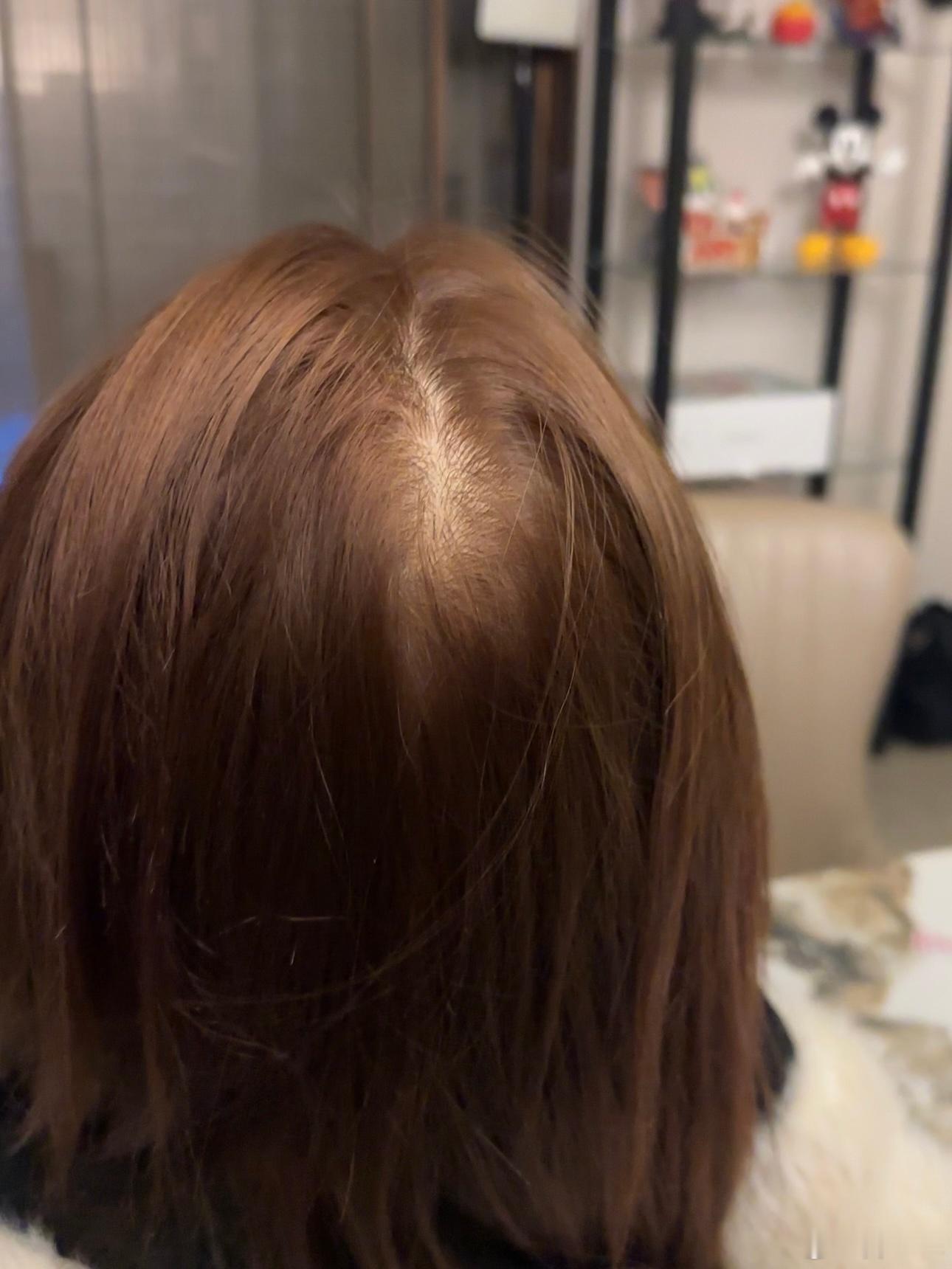 想问这种算秃了吗还是正常发缝啊 第一张是扒开上面的头发 第二张是没扒开[单身狗]