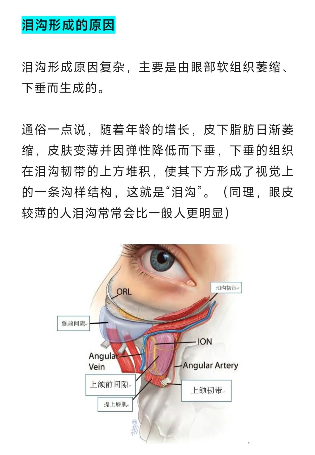 泪沟形成的原因和分型。面部衰老，除了皱纹、下垂、容量缺失三大表现之外，眼部的衰老也是需要特别关注的，有些人才二十几岁但是看起来却很憔悴，可能是泪沟在暗戳戳拉低你的颜值