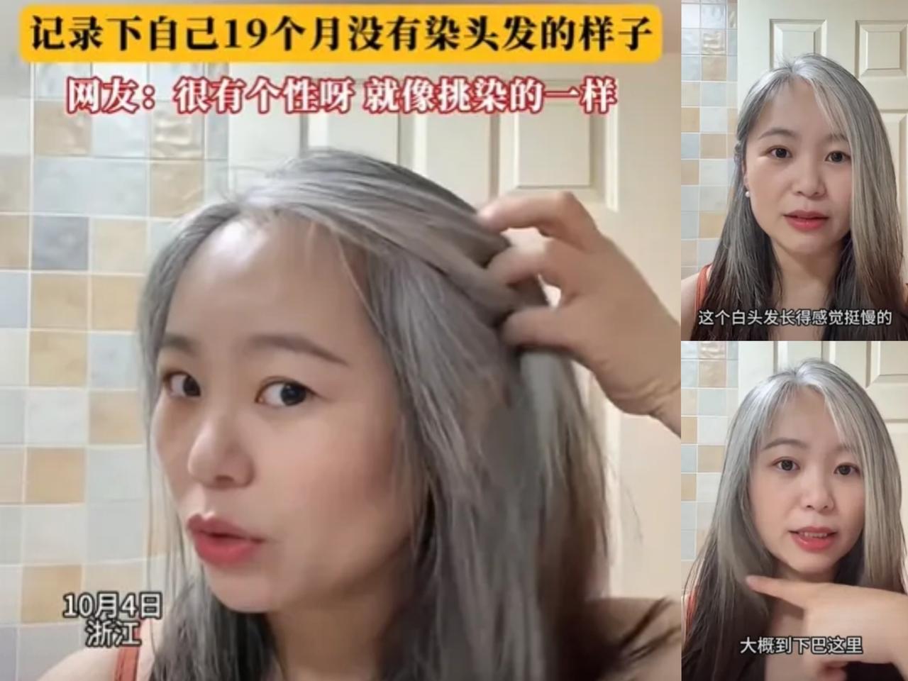浙江一女子发现几根白发，她本以为拔了就是，结果这事儿压根没完，三个月不到，整个脑