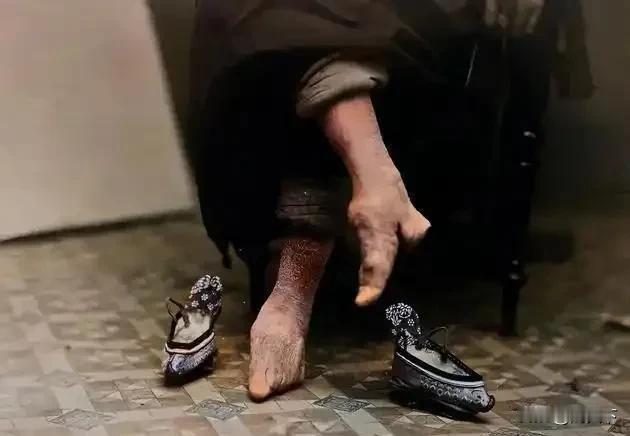 清代有位老妇人脱了鞋，露出的双脚畸形得触目惊心——脚趾与脚跟的骨头拧成一团，早已