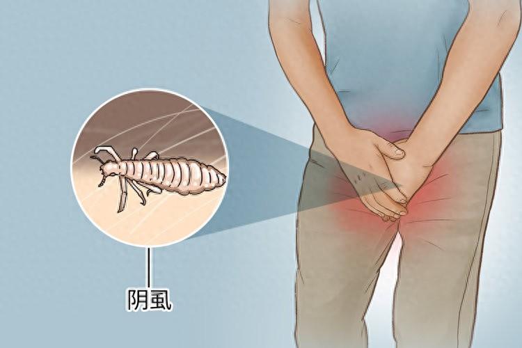 男子腹部痒，医生用镊子夹出12只阴虱！原来阴虱有这3个传播途径

肚子上奇痒无比