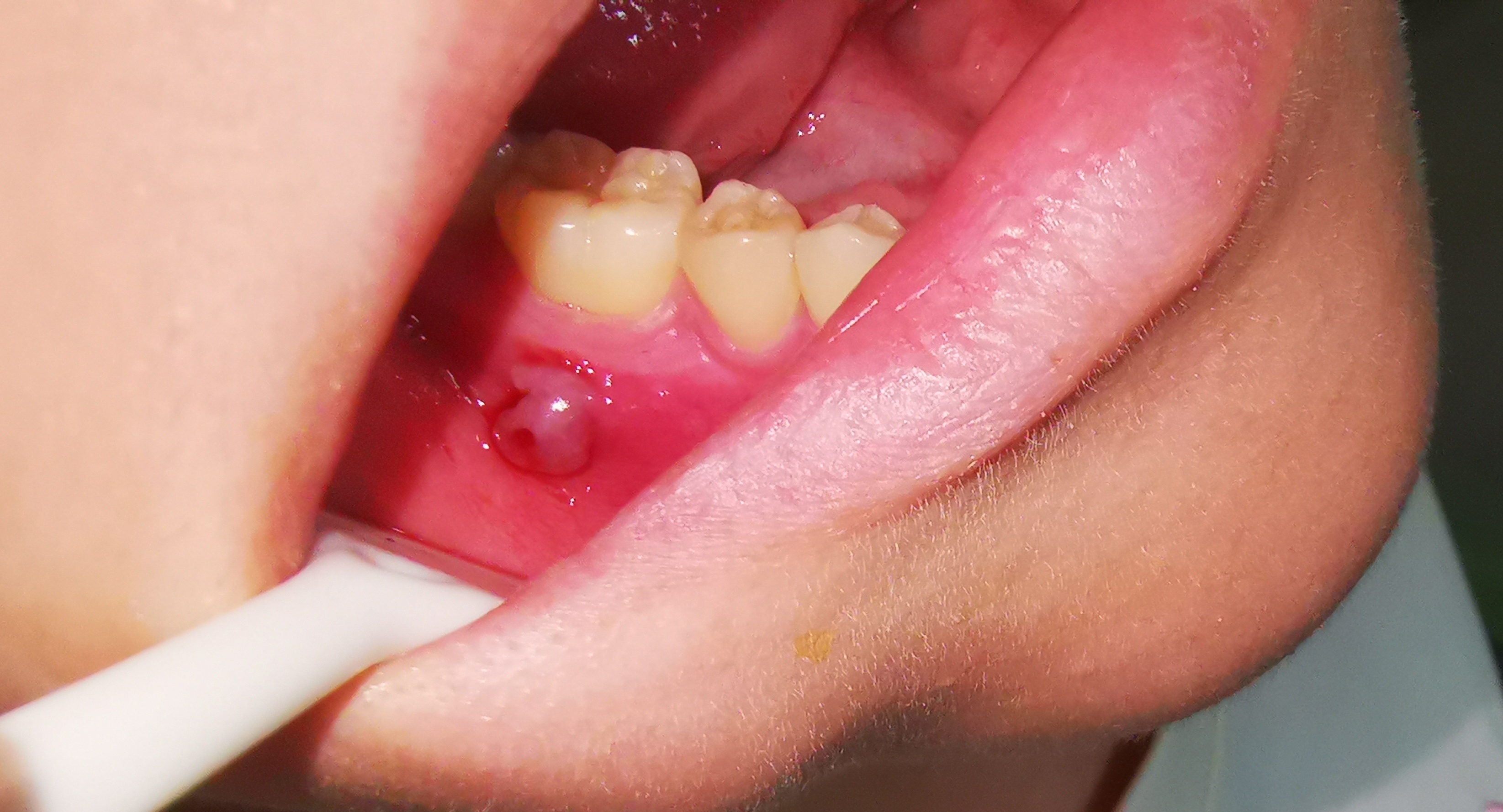 第一眼看过去，你的诊断会是什么？口腔科普 ​​​