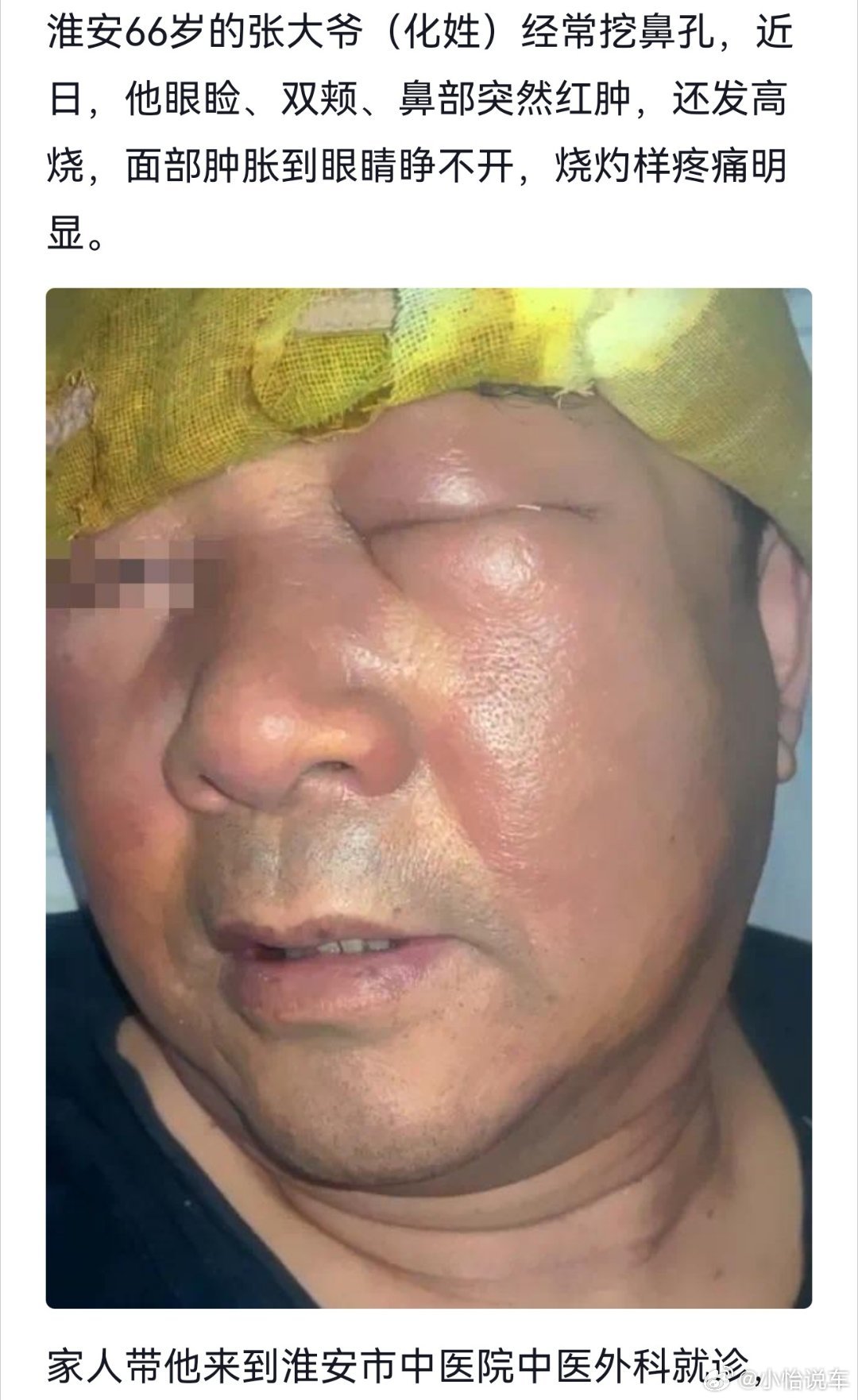 66岁大爷挖鼻孔致满脸肿胀变形挖鼻孔这么吓人吗？一定要改掉这个坏习惯啊！ ​​​