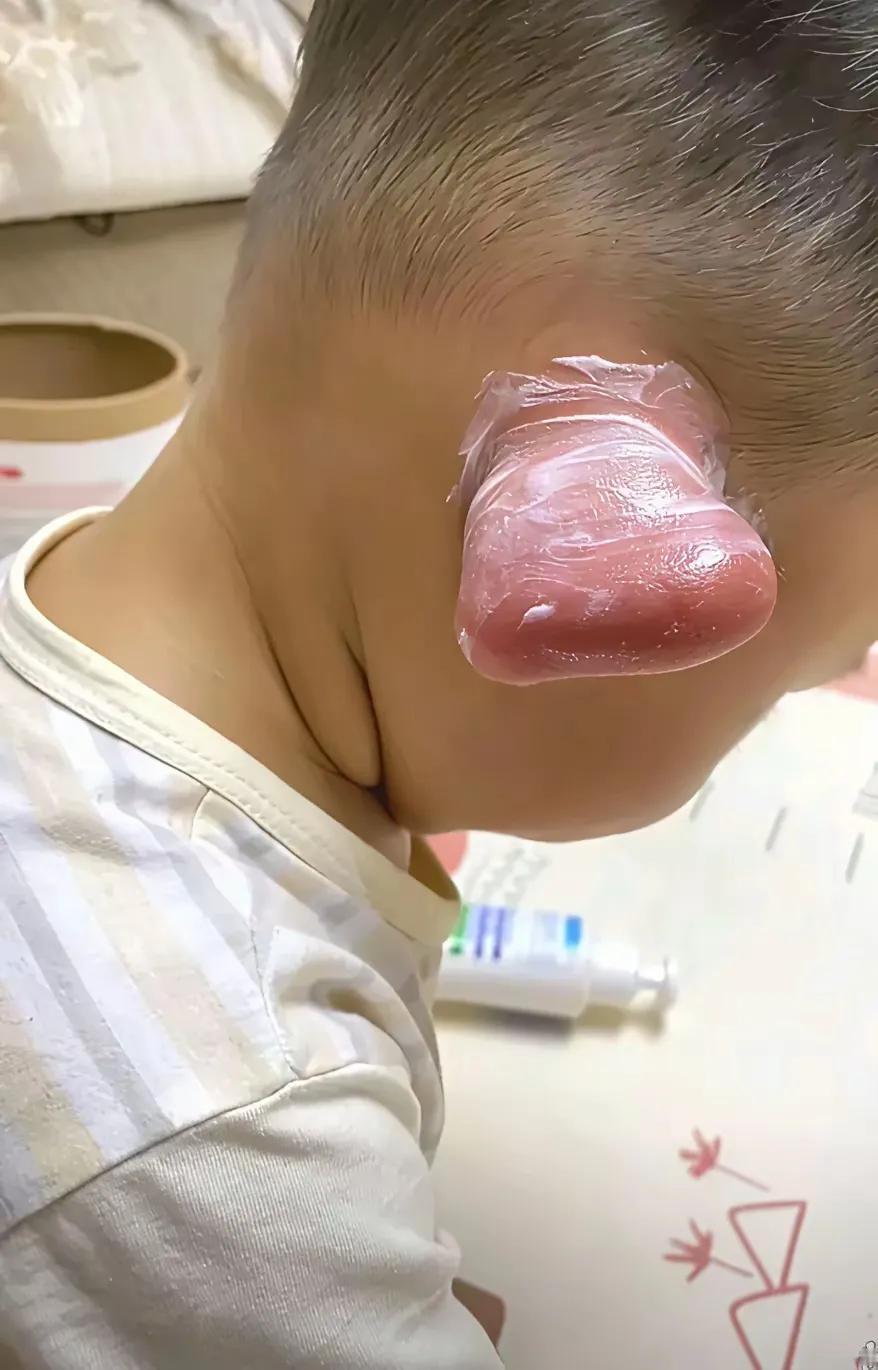 网友:
我滴个乖乖呦！在家带孙子，没想到一觉醒来被蚊子咬成了这样，儿媳妇晚上回来
