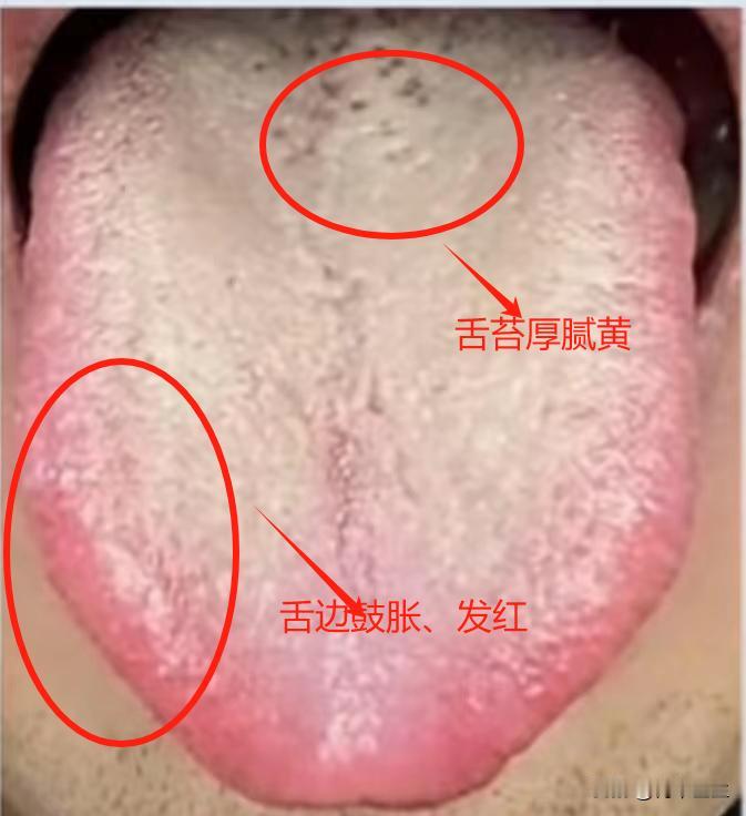 朋友。舌头这样发红，可不是阴虚，你滋阴可就大错特错了

患者主诉：经常失眠，阴囊