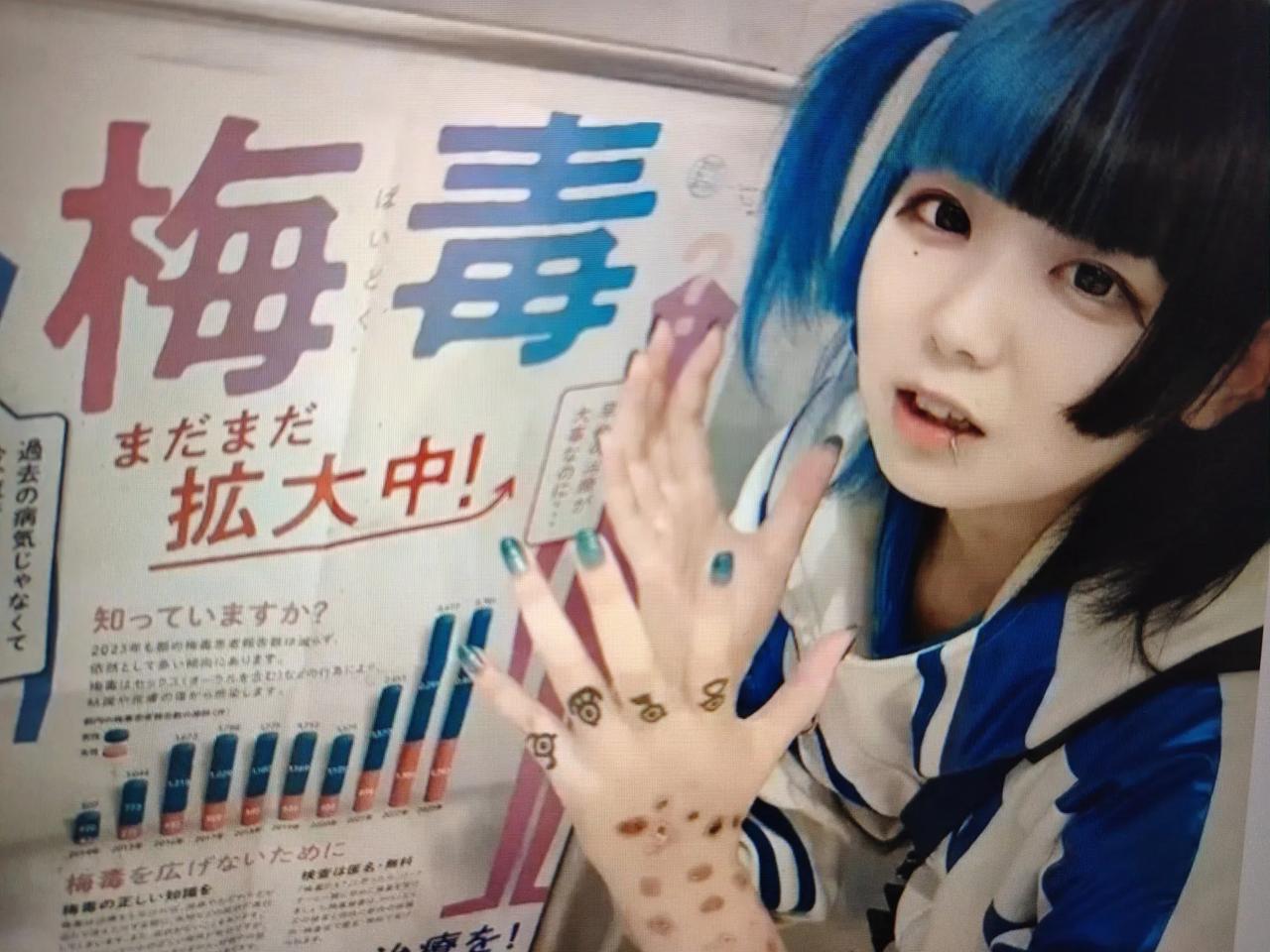 日本梅毒大爆发，青霉素一针见效但短缺30年！

日本梅毒疫情急剧反弹，而核心治疗