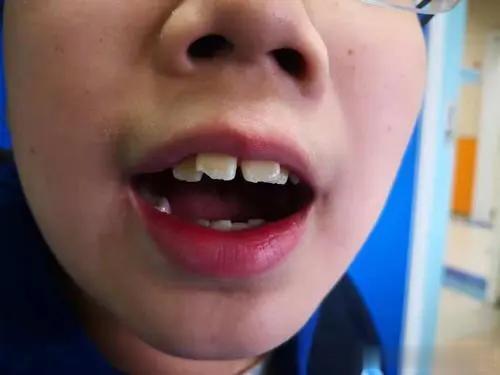 6岁半孩子腺样体堵塞近75%，用这个简单方法，效果看得见！
 
这个小男孩是我去